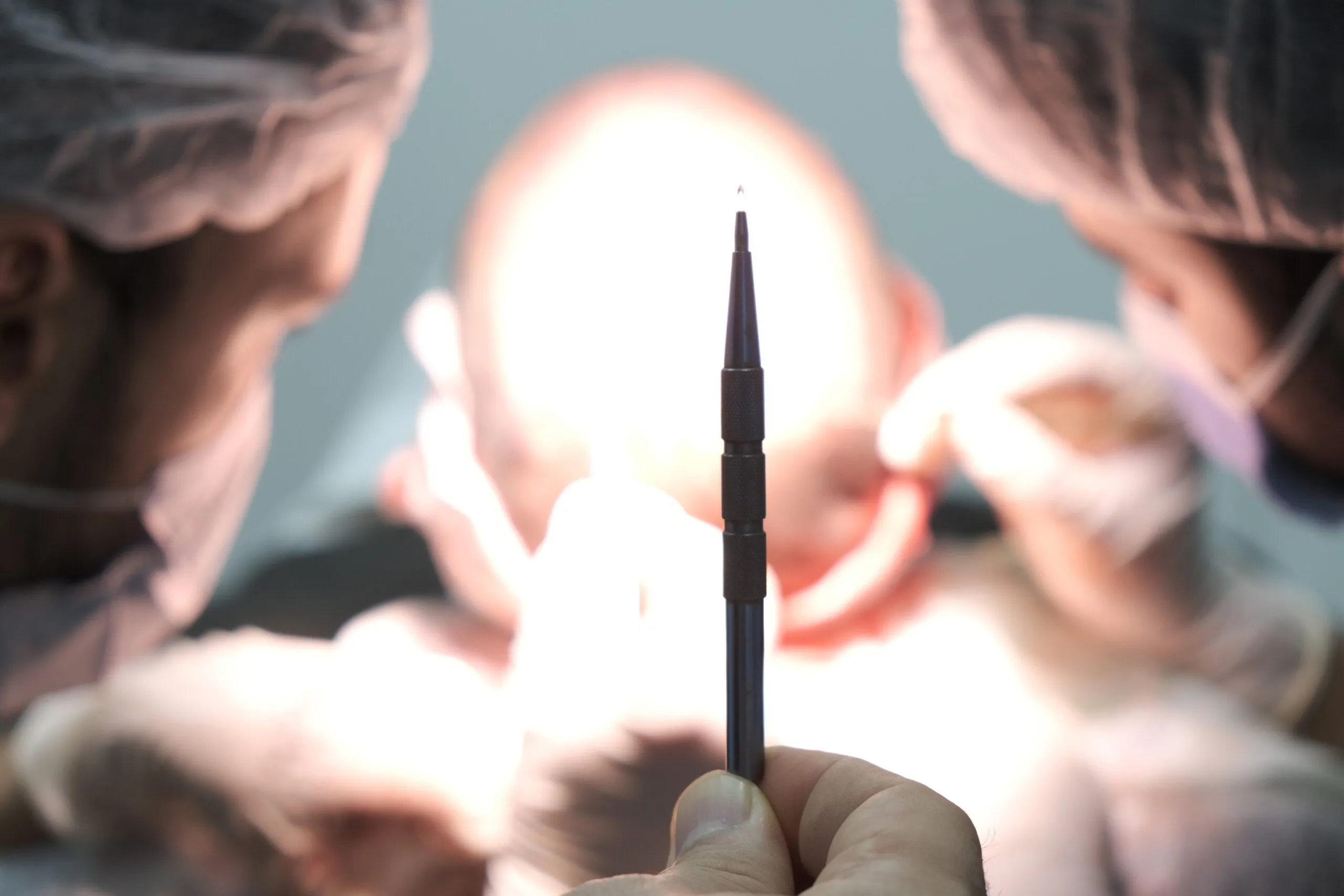 Erhöhte Präzision: Haartransplantation mit Saphirklingen