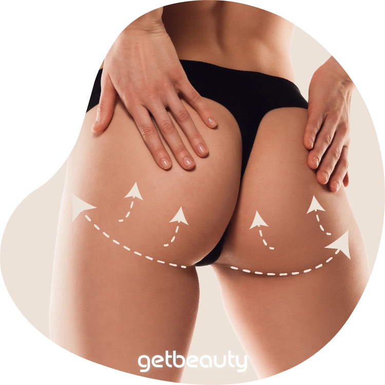 Buttock Lift in Turkey / Antalya – Costs