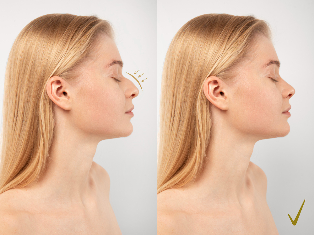 Rhinoplasty in Turkey / Antalya Nose Job Getbeauty Türkiye