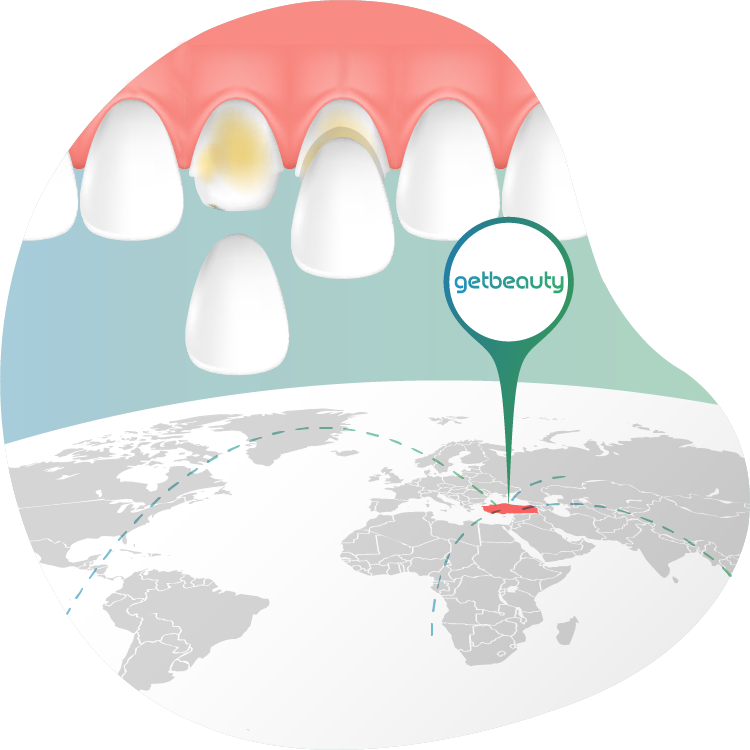 Zahn Veneers im Ausland