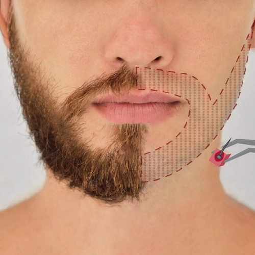Beard Transplant Turkey Antalya
