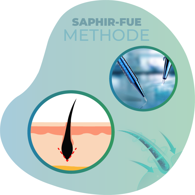 Haartransplantation Saphir-FUE-Methode