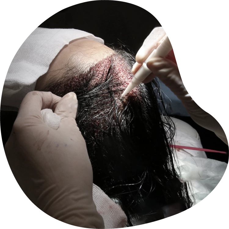 Hair transplant for women abroad