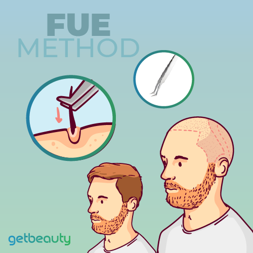 Hair Transplant Turkey FUE Method