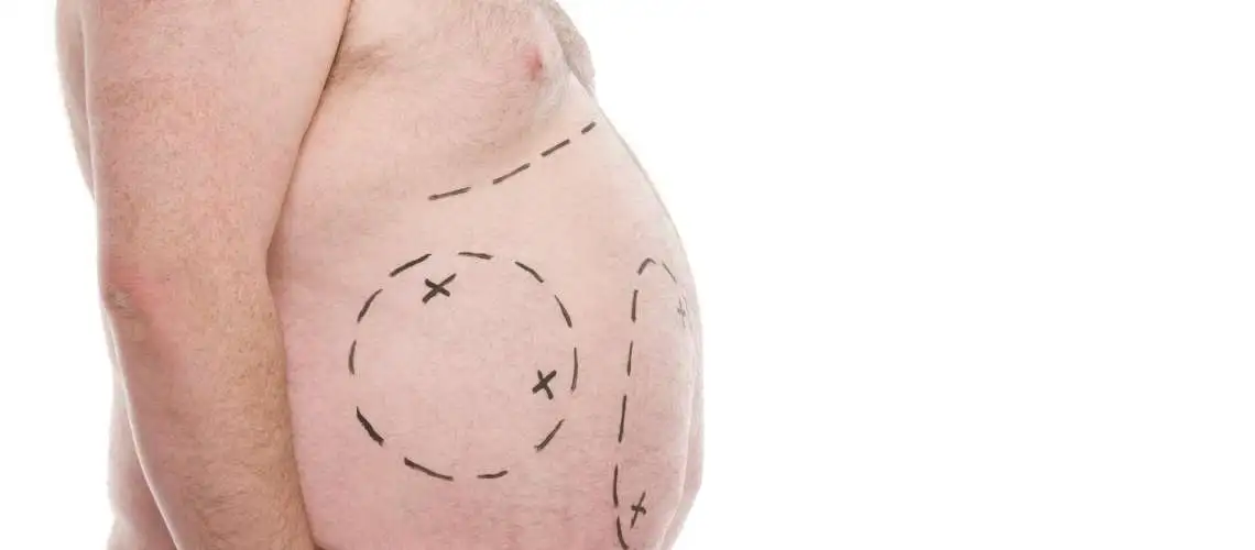 Liposuktion für Männer: Alles über männliche Körperkonturierung