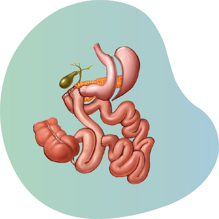 Adjustments to Gastric Bypass