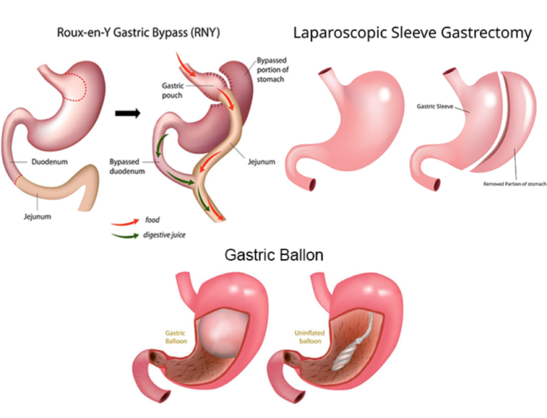 Gastric Surgery in Turkey: Both gastric sleeve surgery and gastric bypass are proven weight loss procedures...