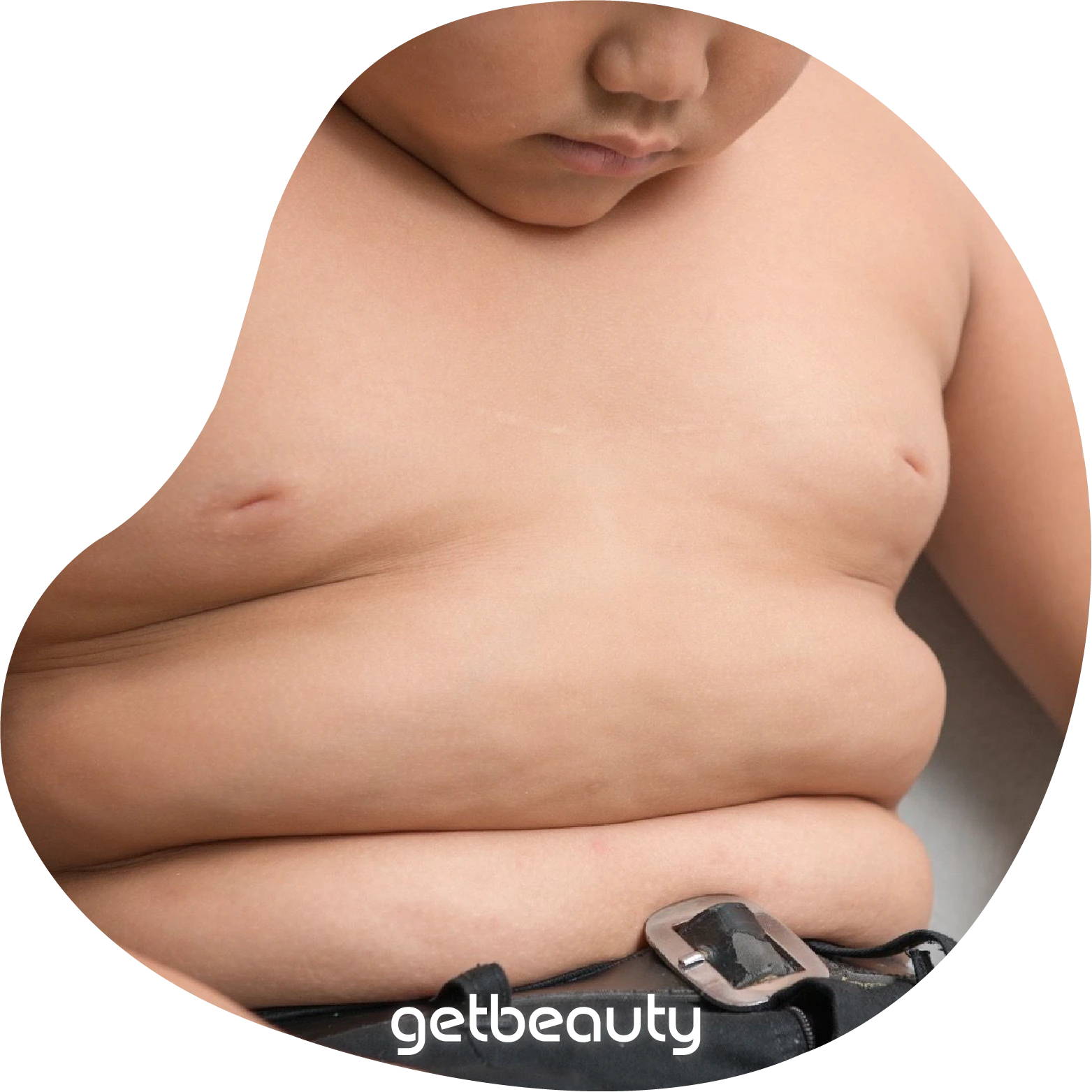 Obesity Surgery Children Teens Turkey Stomach reduction in children and adolescents