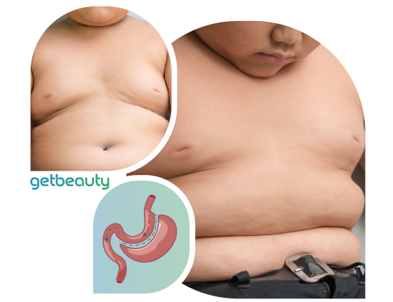 Obesity Gastric Reduction in Children and Adolescents Bariatric Surgery