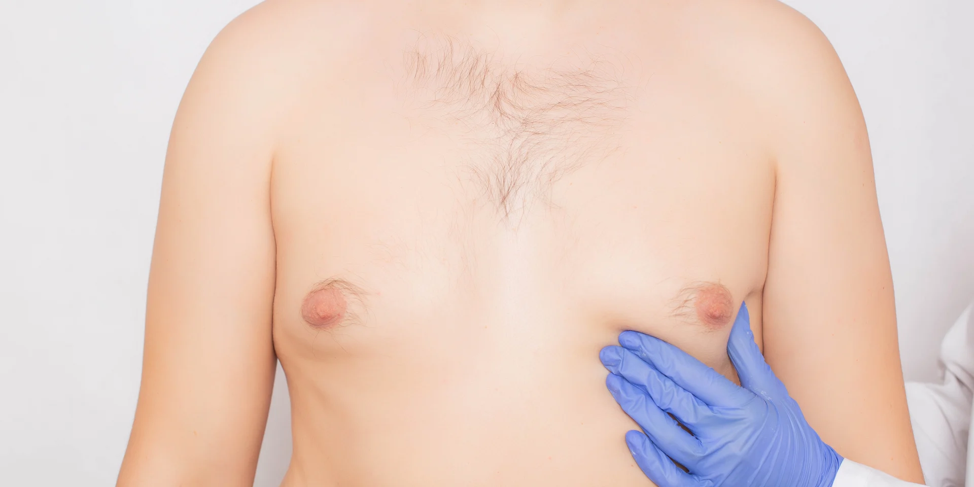 Benefits of Gynecomastia Surgery in Turkey (Male Breast)