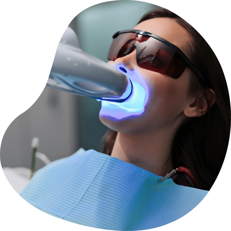 Teeth Whitening for a Hollywood smile