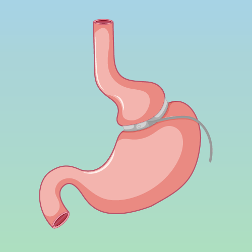 Weight Loss Surgery Turkey: Gastric Band